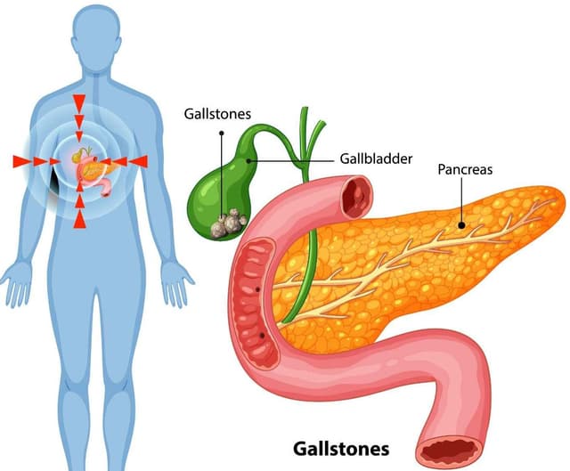 Bariatric Surgery